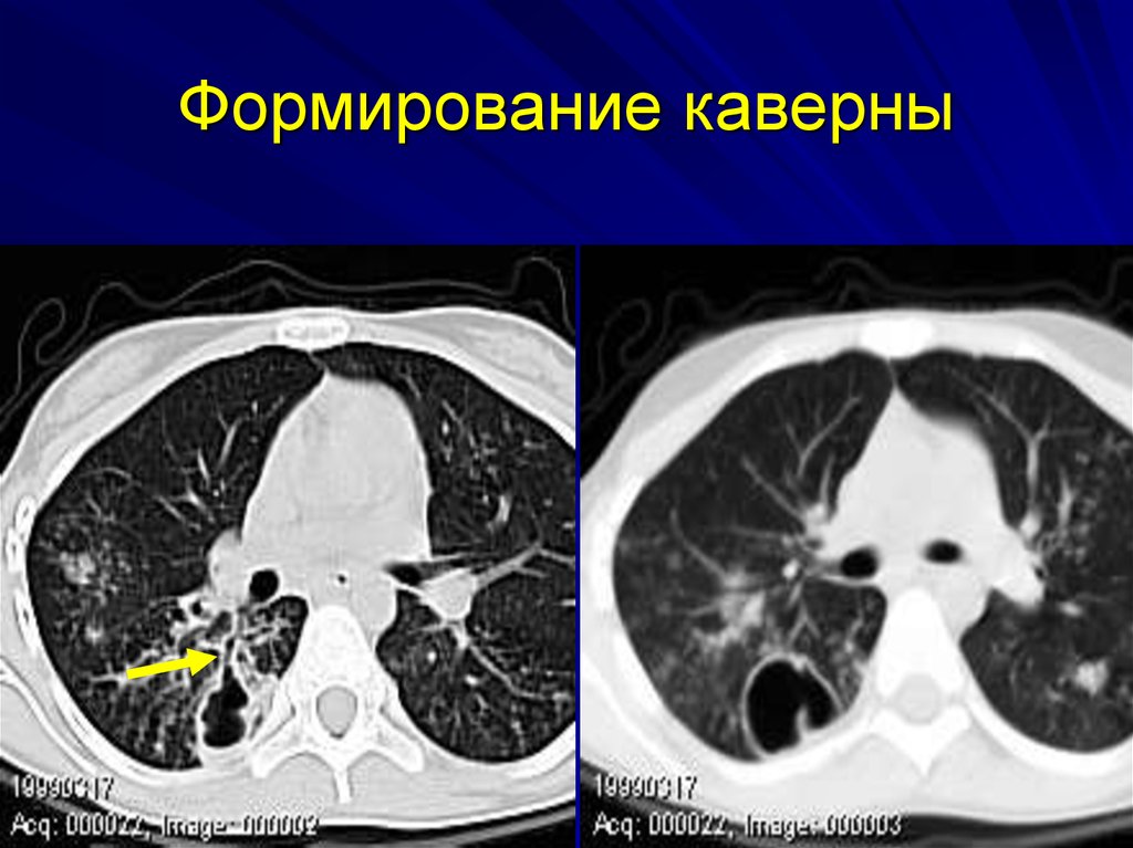 Картина кт при туберкулезе