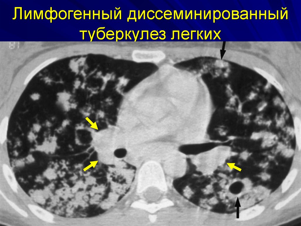 С чем можно перепутать туберкулез легких на снимке компьютерной томографии