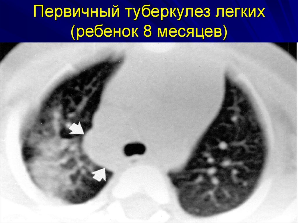 С чем можно перепутать туберкулез легких на снимке компьютерной томографии