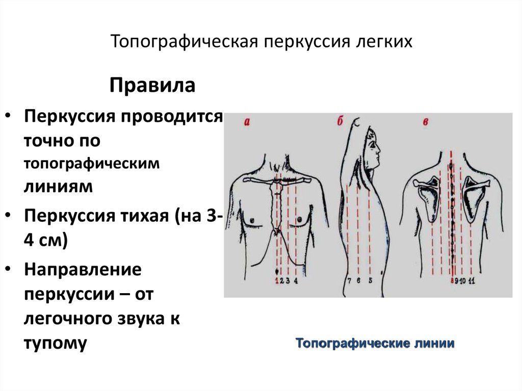 Линии легких. Точки топографической перкуссии легких норма. Сравнительная перкуссия грудной клетки в норме. Сравнительная и топографическая перкуссия легких. Топографическая перкуссия легких пропедевтика.