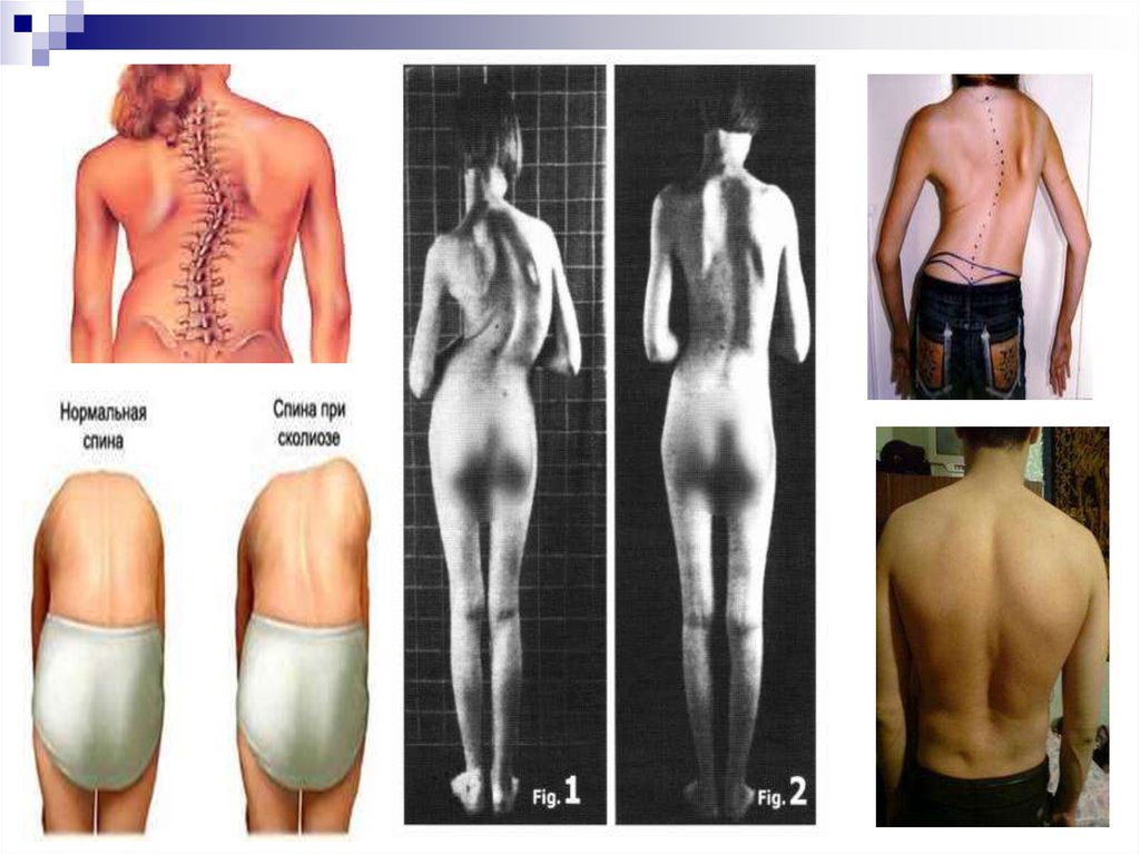 Нормальная поясница. Нормальная спина. Миопатический сколиоз. Спина нормального человека. Спина при сколиозе и нормальная.