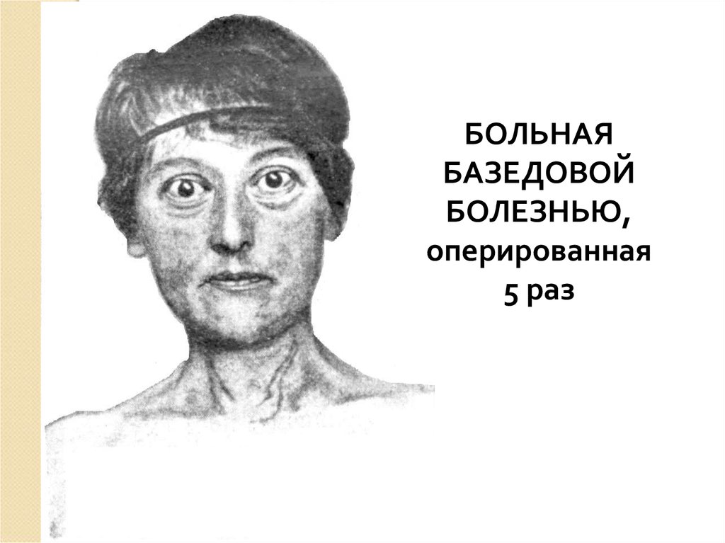 Базедова болезнь. Стив Бушеми базедова болезнь. Известные люди с базедовой болезнью. Базедова болезнь картинки. Базедова болезнь рисунок.