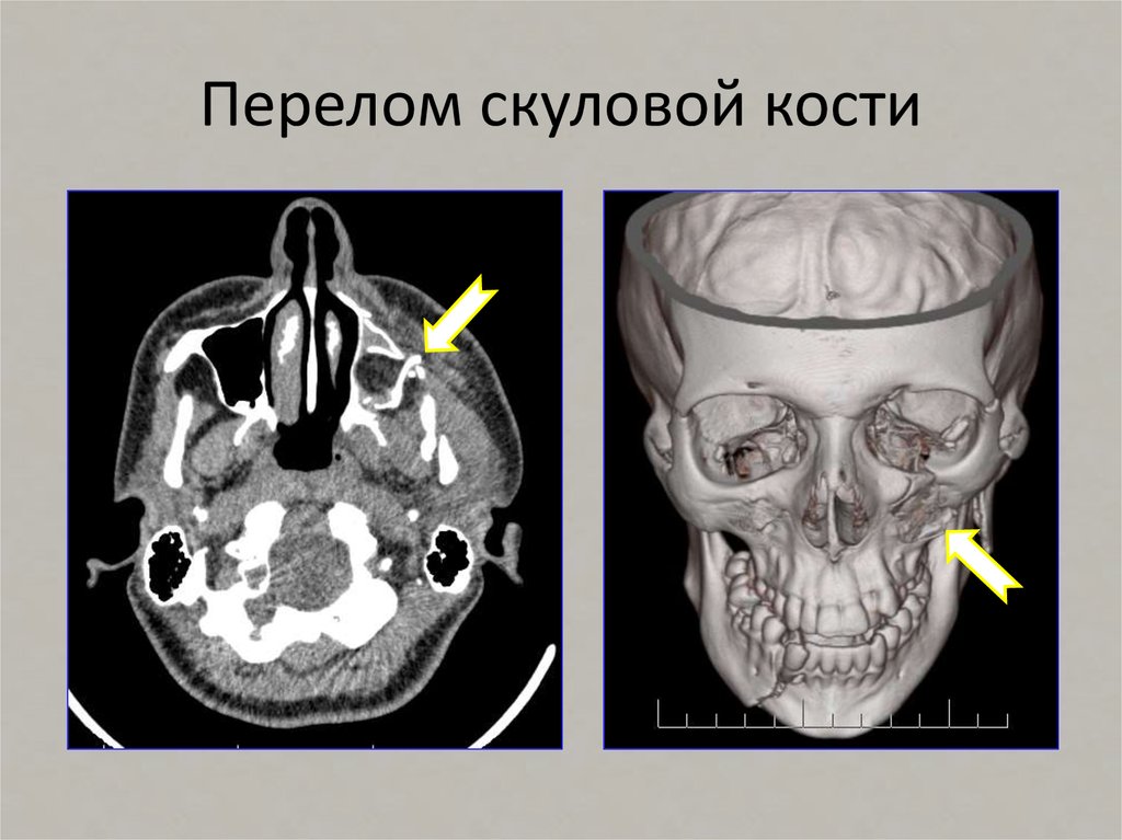 Переломы скуловой кости и дуги презентация