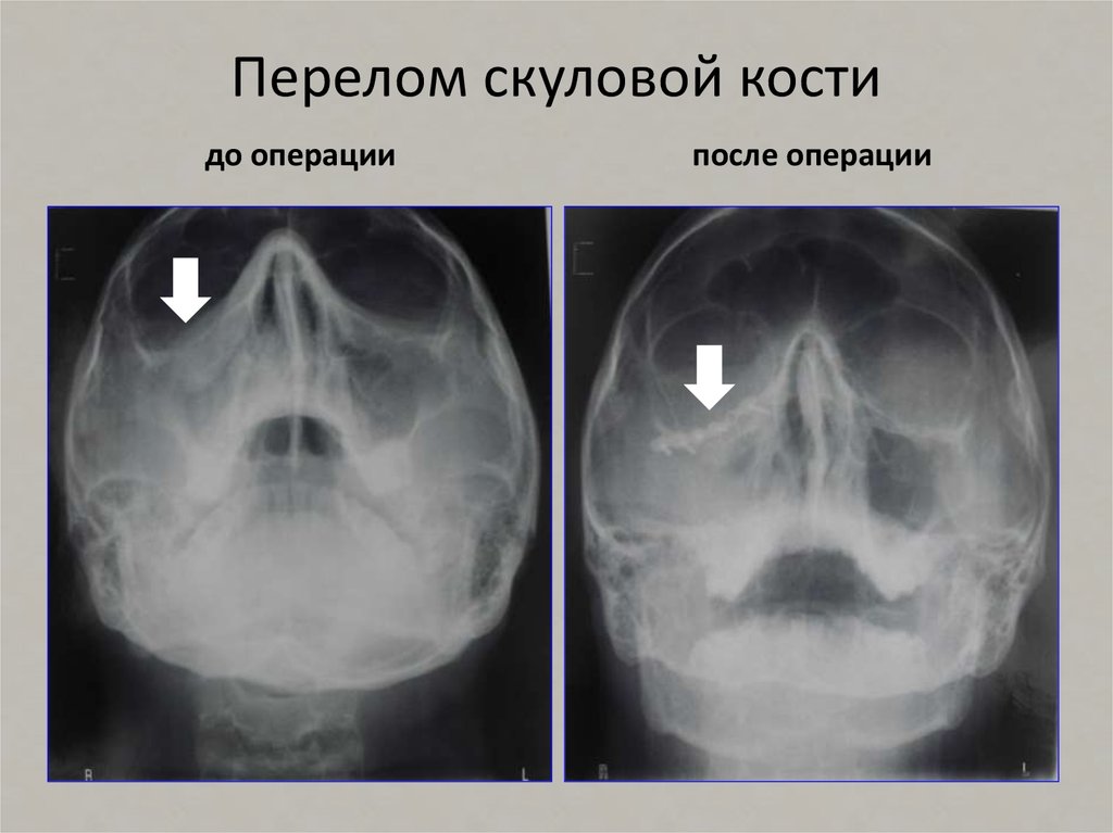 Переломы скуловой кости и дуги презентация