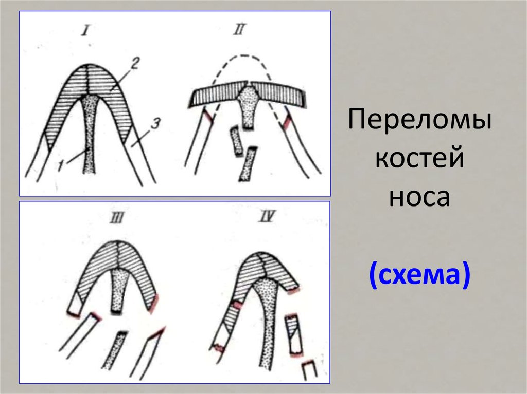 Закрытый перелом носа карта вызова