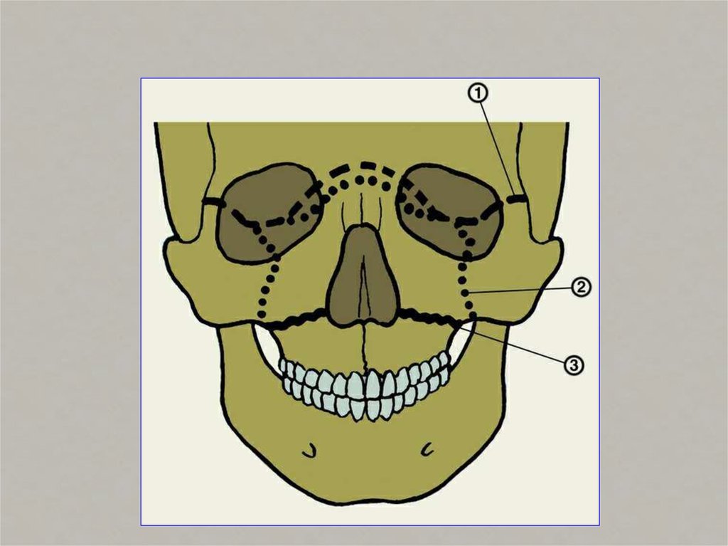 Линия челюсти. Суббазальный перелом верхней челюсти. Перелом нижней челюсти Лефор. Суббазальный перелом верхней челюсти Лефор. Перелом верхней скуловой кости.