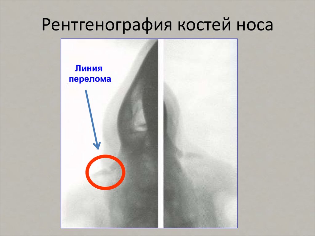 Визуализация костей носа