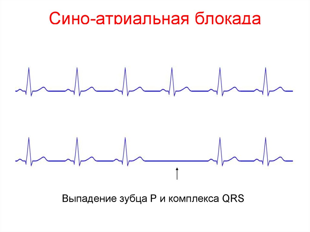 Блокады сердца на ЭКГ. Сино атриовентрикулярная блокада. Сино атриальная блокада 3 стенепни. Сино атриальная экстрасистола.