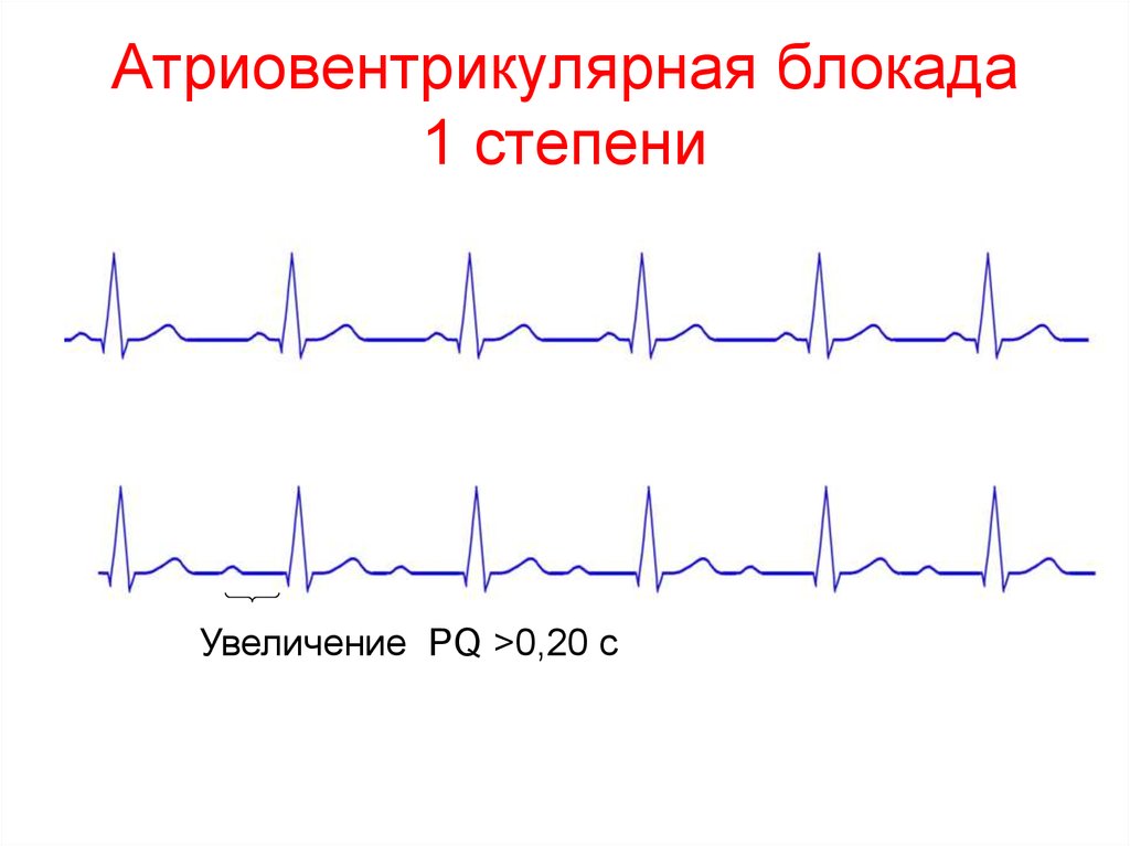 Ав блокады на экг картинки