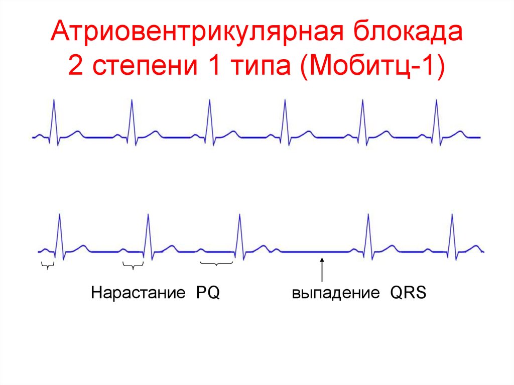 Типы са блокад. АВ блокада 2 степени Мобитц 1 на ЭКГ. АВ блокада 2 степени Мобитц 2 на ЭКГ. Av блокада 2 степени Мобитц 1 на ЭКГ. ЭКГ атриовентрикулярная блокада Мобиц 2.