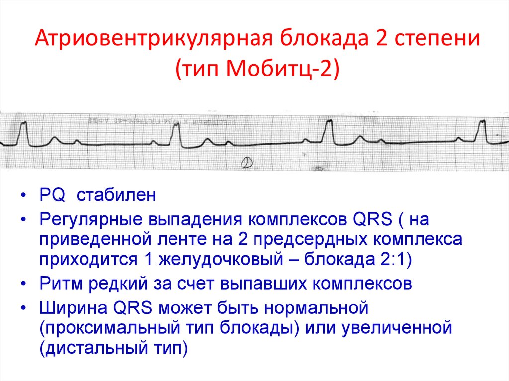 Ав блокада 2 мобитц 1