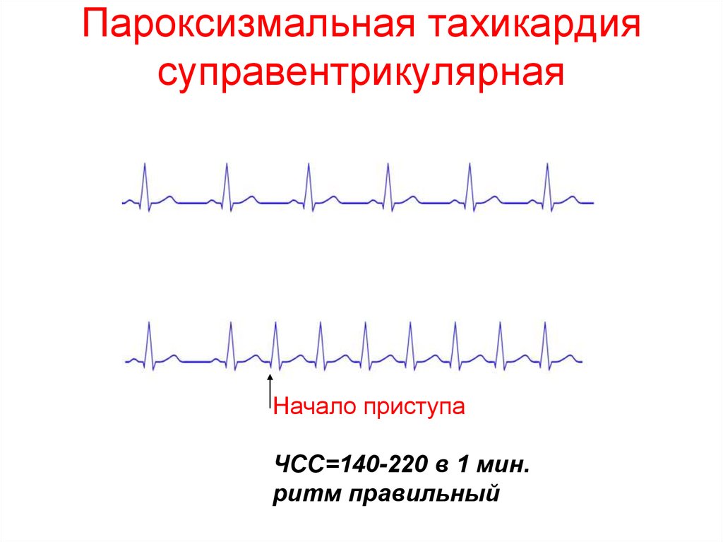 Экг картина при пароксизме суправентрикулярной тахикардии имеет вид