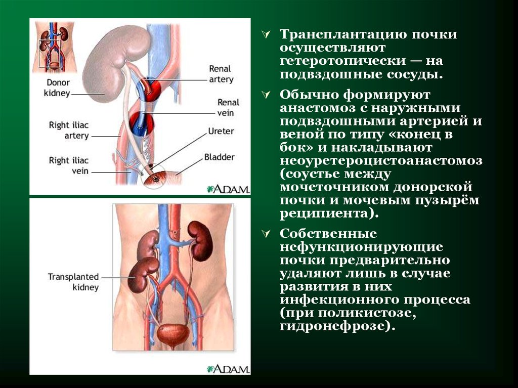 Трансплантация почки схема