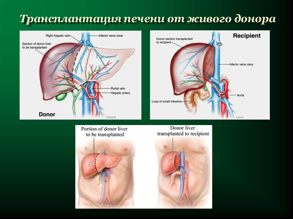 Пересадка органа от донора. Техника ортотопической трансплантации печени. Трансплантология печени. Трансплантация печени схема.