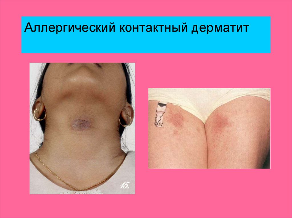 Аллергический контактный дерматит