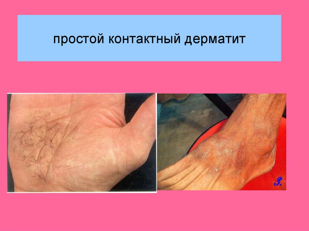 Дерматиты. Классификация - презентация онлайн