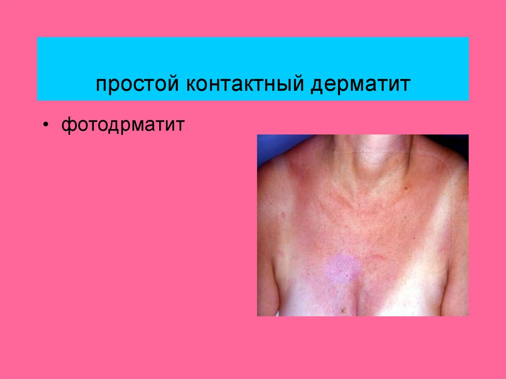 Дерматиты. Классификация - online presentation