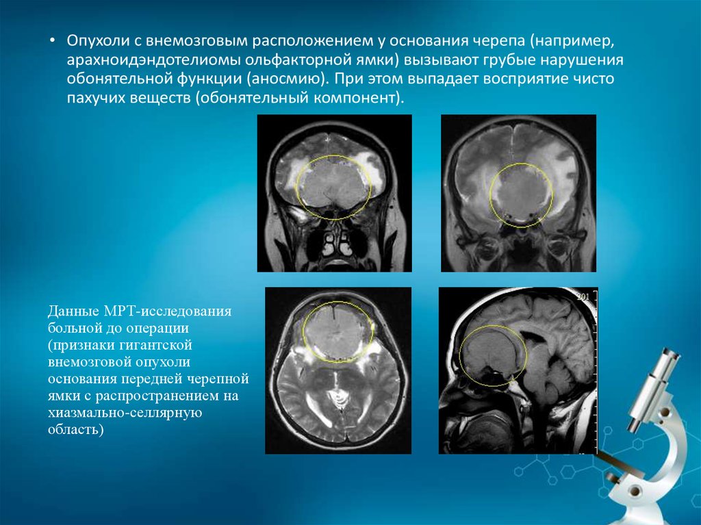 Объемное образование. Опухоли хиазмально-селлярной области. Опухоль ольфакторной ямки. Внемозговые опухоли головного. Опухоль головного мозга ольфакторной ямки.