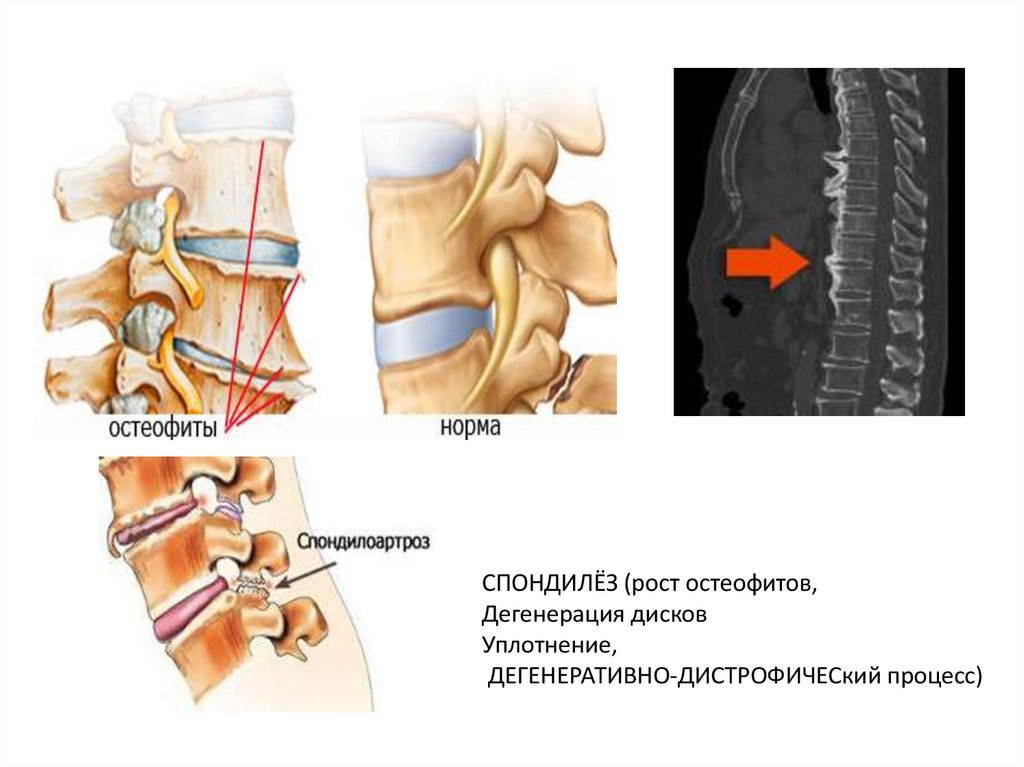 Спондилез поясничного. Спондилоартроз болезнь Бехтерева. Спондилоартроз пояснично-крестцового отдела позвоночника. Спондилоартроз пояснично-крестцового отдела позвоночника мрт. Спондилоартроз 2 степени.