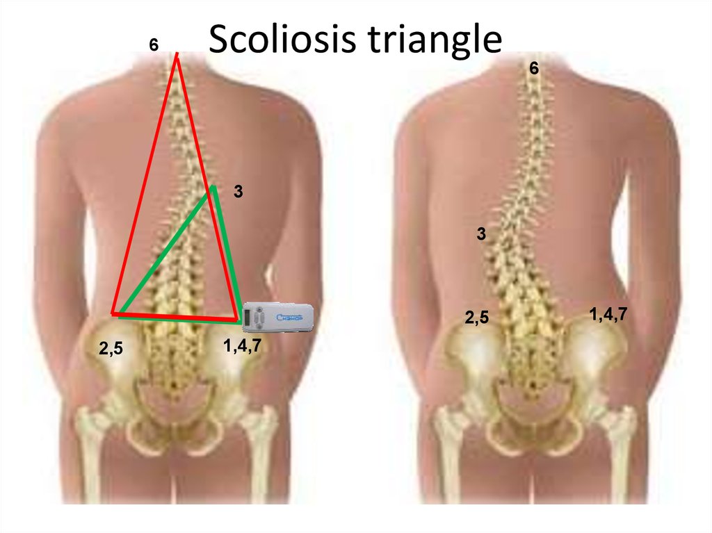 Scoliosis triangle