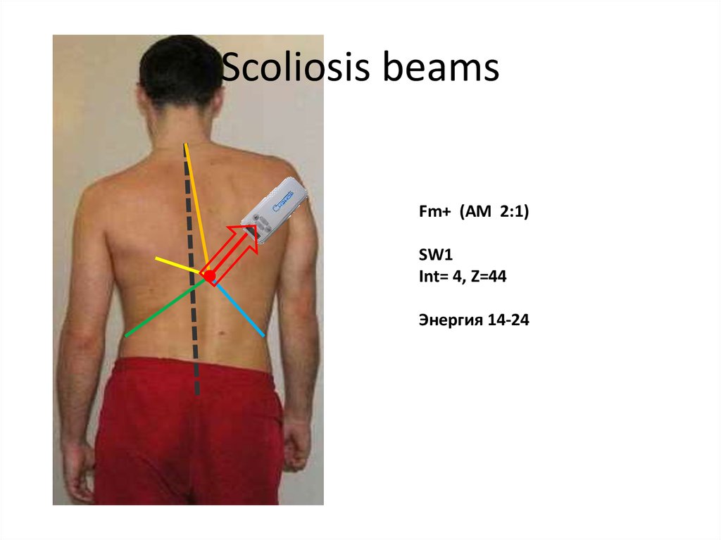 Scoliosis beams