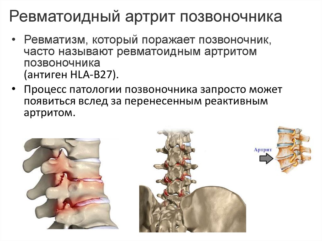 Ревматоидный артрит позвоночника