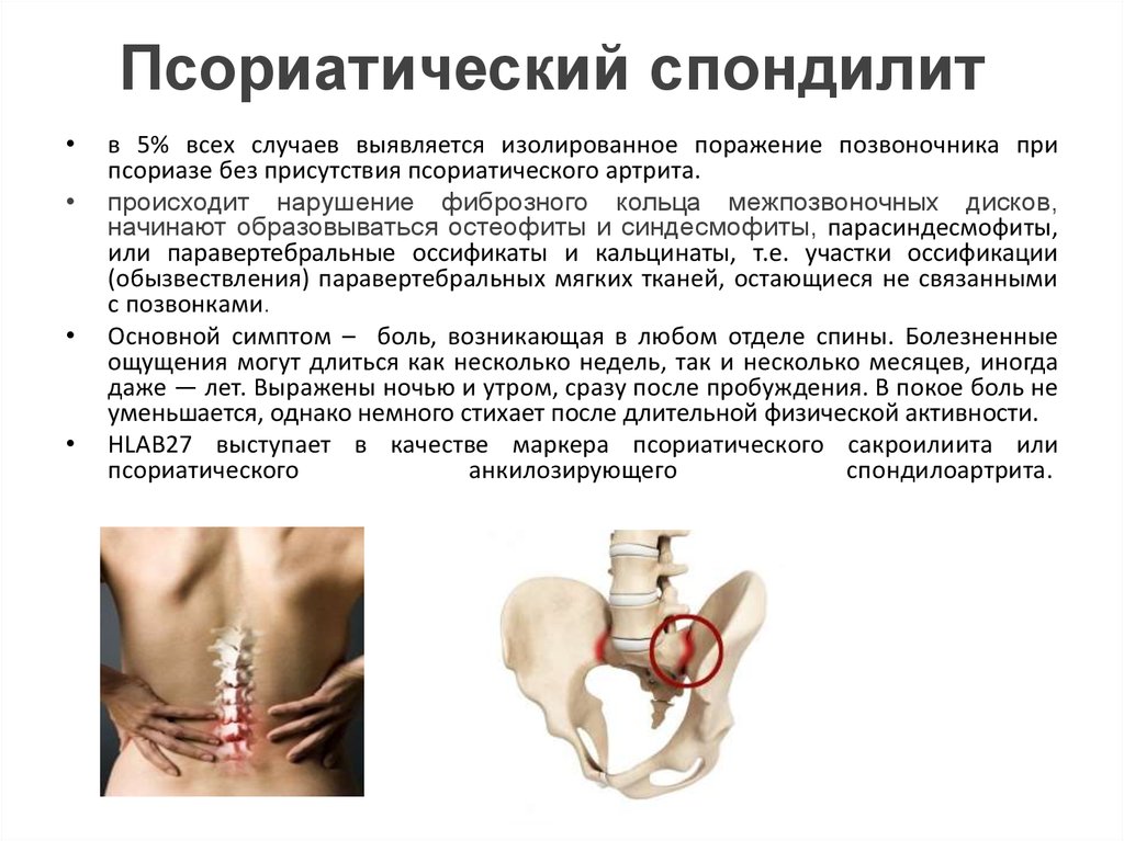 Псориатический спондилит