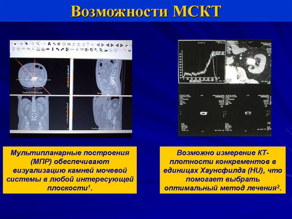 Мочекаменная болезнь карта смп