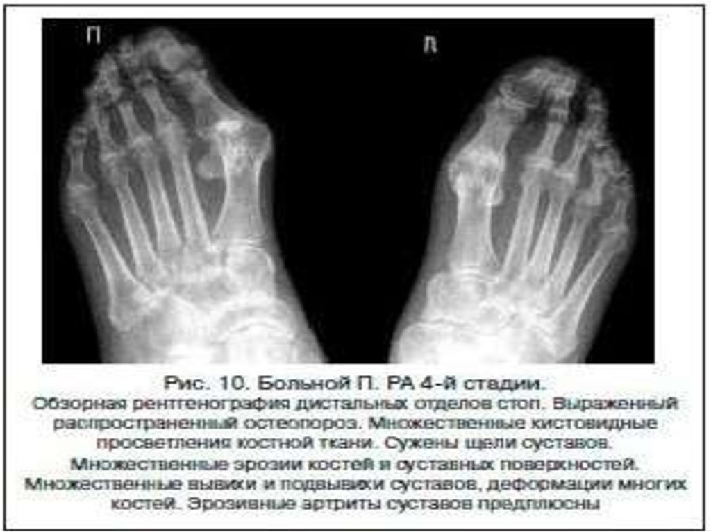 Остеопороз стопы. Артроз кистей рентген протокол. Остеопороз стопы рентген. Артроза в суставах среднего отдела стопы.