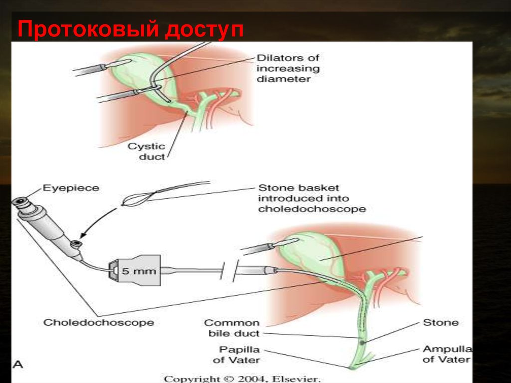 Механическая желтуха. Механическая желтуха операции. Стадии механической желтухи. Операции при механической желтухе. Синдром механической желтухи хирургия.