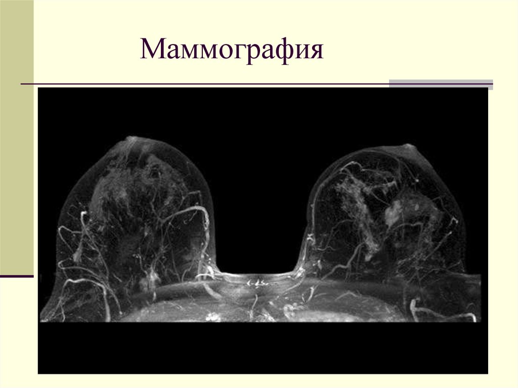 Маммография проекции. Мрт молочных желез презентация. Типы кинетических кривых на мрт молочных желез.