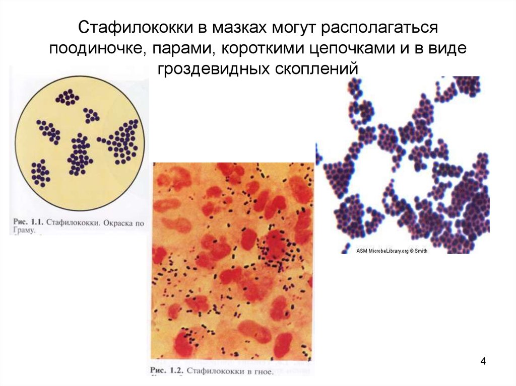Staphylococcus aureus степени. Стафилококк ауреус мазок. Стафилококкус ауреус. Мазок чистой культуры s aureus. Золотистый стафилококк мазок.