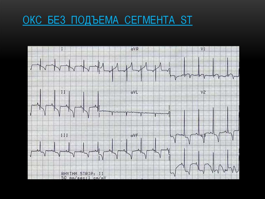 Оим с подъемом st. ЭКГ Окс без подъема сегмента St. Подъем сегмента St на ЭКГ. Инфаркт миокарда без подъема St. Окс с подъёмом St ЭКГ.