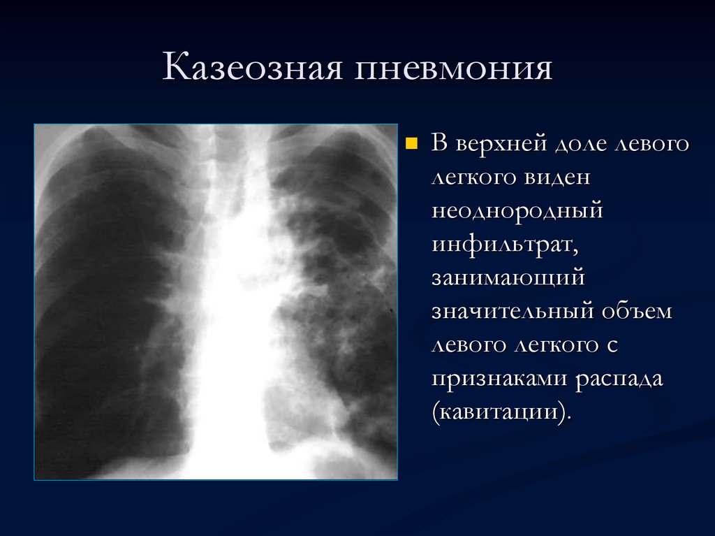 Казеозная пневмония презентация