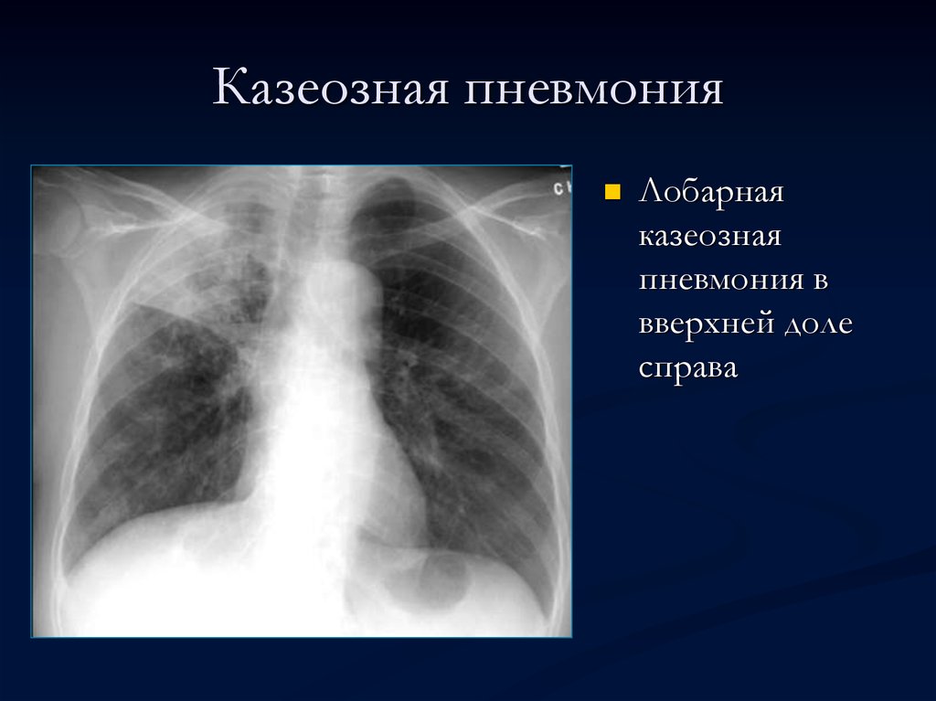 Казеоз это. Казеозная пневмония рентген. Казеозный туберкулез рентген. Казеозная пневмония туберкулез. Казеозная пневмония рентгенограмма.