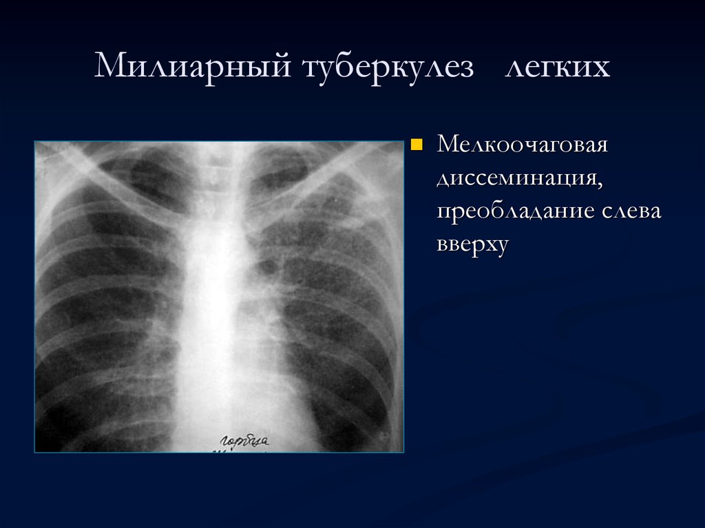 Милиарный туберкулез. Милиарный диссеминированный туберкулез рентген. Милиарный и кавернозный туберкулез. Мелкоочаговый туберкулез легких рентген. Милиарный туберкулез рентген.