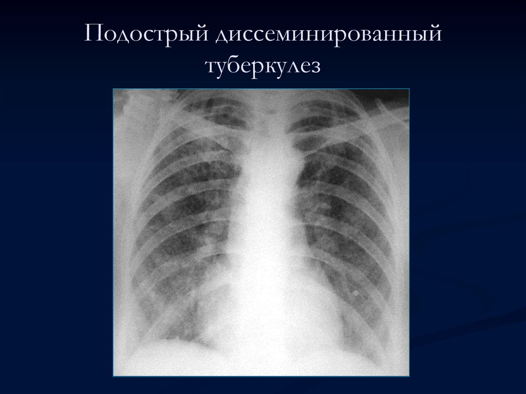 Формы диссеминированного туберкулеза. Диссеминированный туберкулёз лёгких подострый рентген. Подострый диссиминированный туберкулёз рентген. Диссеминированный туберкулез на рентгенограмме. Острый диссеминированный туберкулез рентген.
