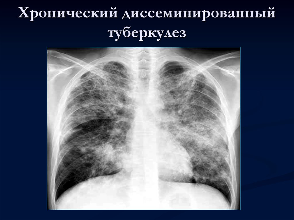 Симптомы легкого течения. Острый диссеминированный туберкулез рентген. Хронический диссеминированный туберкулез легких рентген. Острый гематогенно-диссеминированный туберкулез рентген. Острый милиарный диссеминированный туберкулез.