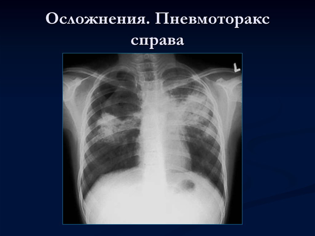 Спонтанный пневмоторакс картинки