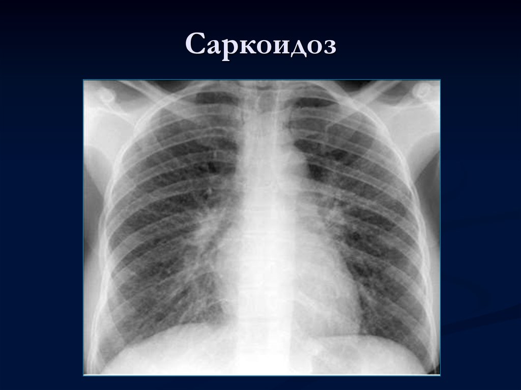 Легкие увеличен узел. Саркоидоз внутригрудных лимфоузлов рентген. Саркоидоз лимфоузлов легких. Саркоидоз внутригрудных лимфатических узлов рентген. Саркоидоз лимфоузлов средостения.