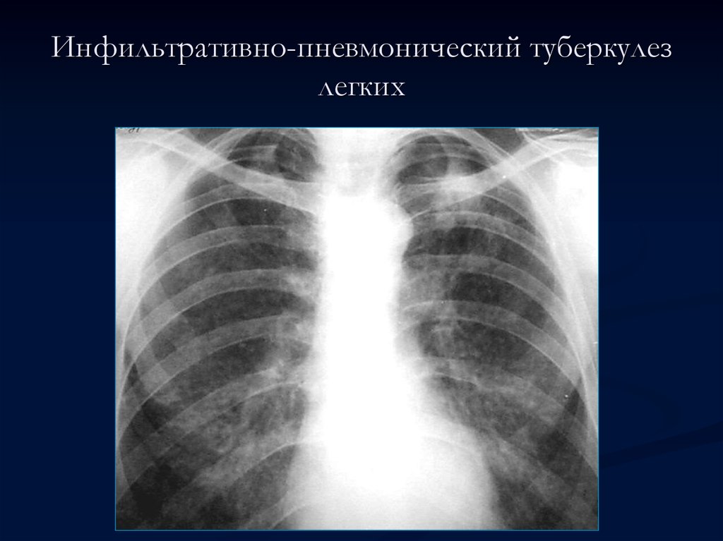 Инфильтративный распад легких. Инфильтративный инфильтративный туберкулез. Инфильтративный туберкулез бронхолобулярный инфильтрат. Инфильтративный туберкулез снимок. Инфильтративный туберкулез рентгенография.