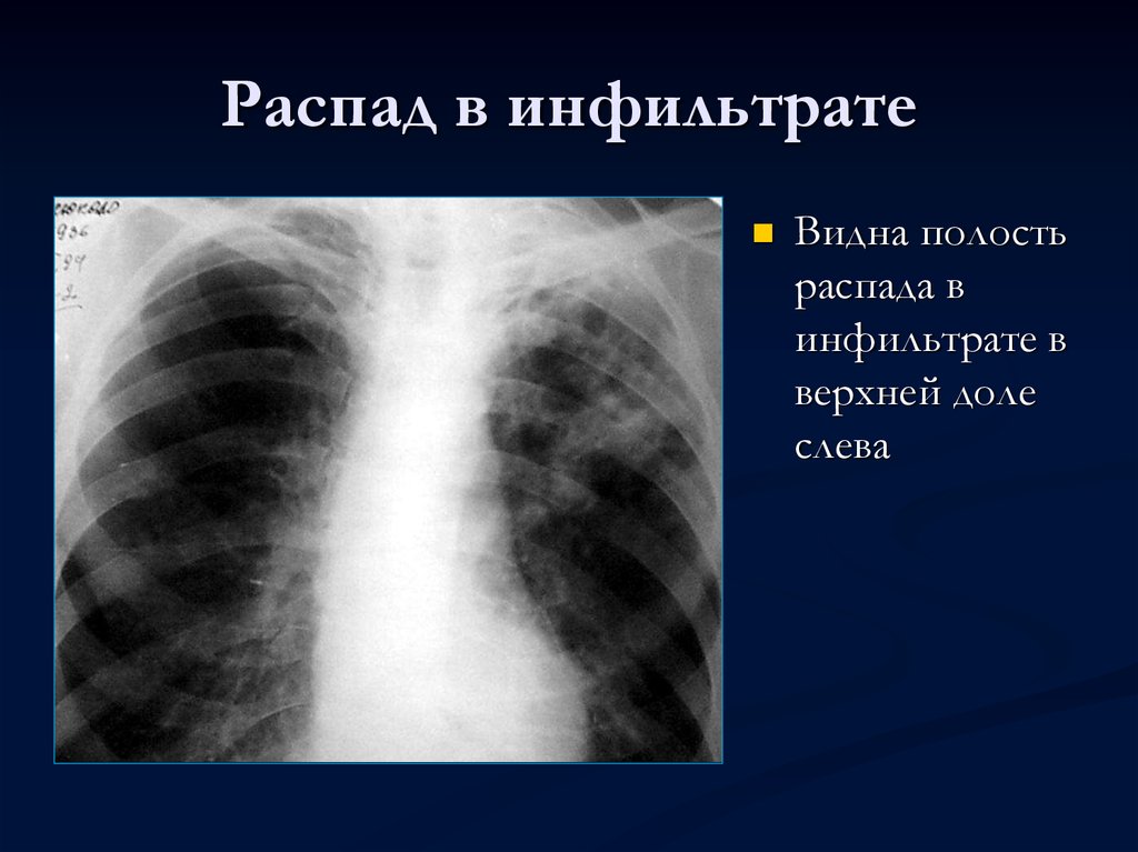 Туберкулез легких в фазе инфильтрации. Инфильтративный туберкулез рентгенография. Инфильтративный туберкулез в фазе распада. Инфильтративный туберкулез с распадом рентген. Инфильтративный туберкулез в фазе распада рентген.