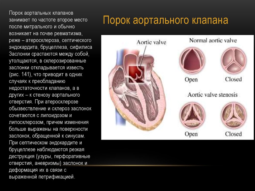 Митральный аортальный стеноз. Порок аортального клапана сердца. Клапан аорты порок сердца. Приобретенные пороки аортального клапана недостаточность. Приобретенные пороки аортального и митрального клапана.