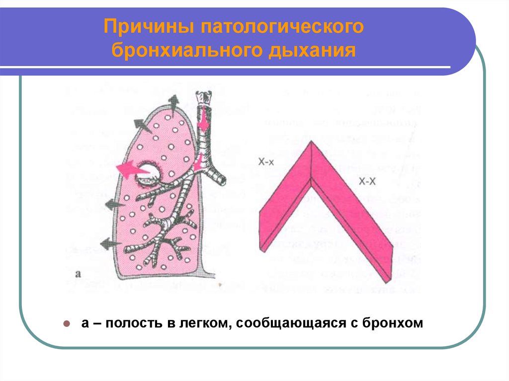 Полости в бронхах. Полостное бронхиальное дыхание. Полость в легких, сообщающаяся с бронхом. Образование полости в легком. Синдром полости в легком сообщающейся с бронхом.