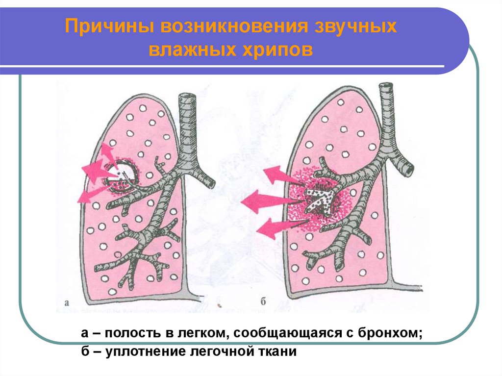 Образование полостей в легких