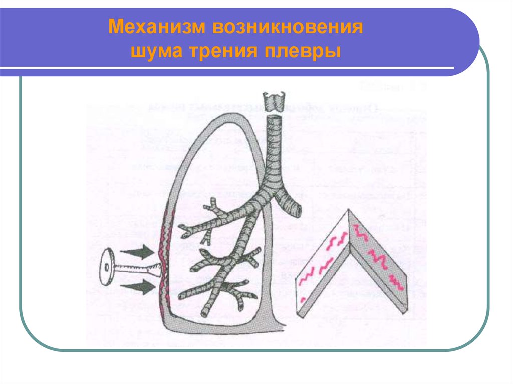 Шум трения. Шум трения плевры механизм возникновения. Механизм появления шума трения плевры. Механизм возникновения шума плевры. Механизм образования шума трения плевры.