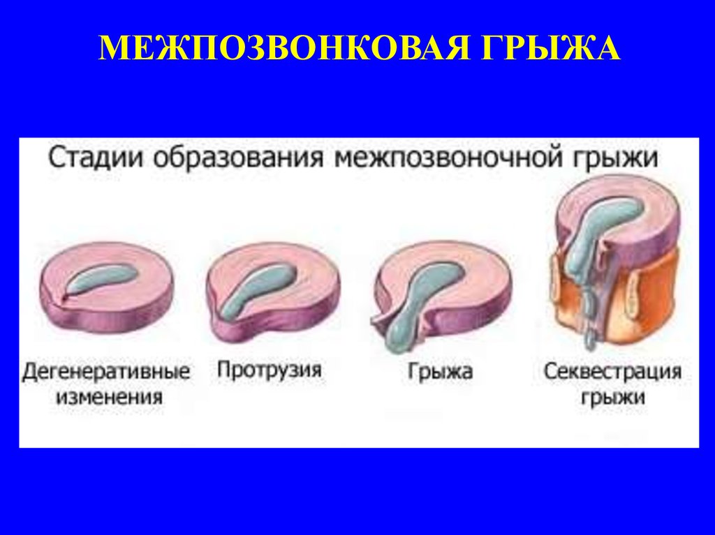 Радикулопатии - презентация онлайн