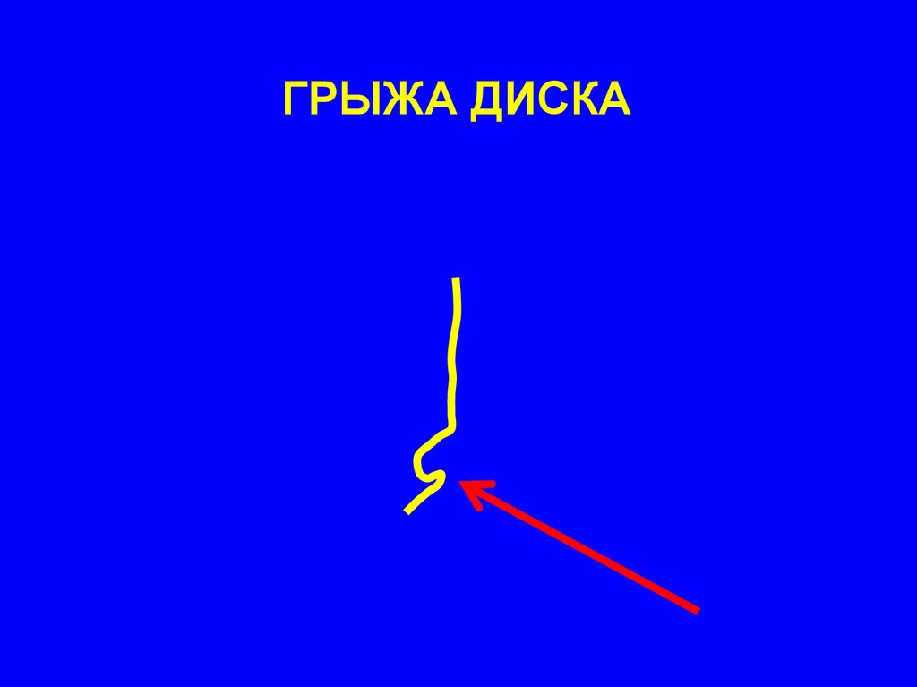 Радикулопатии - презентация онлайн