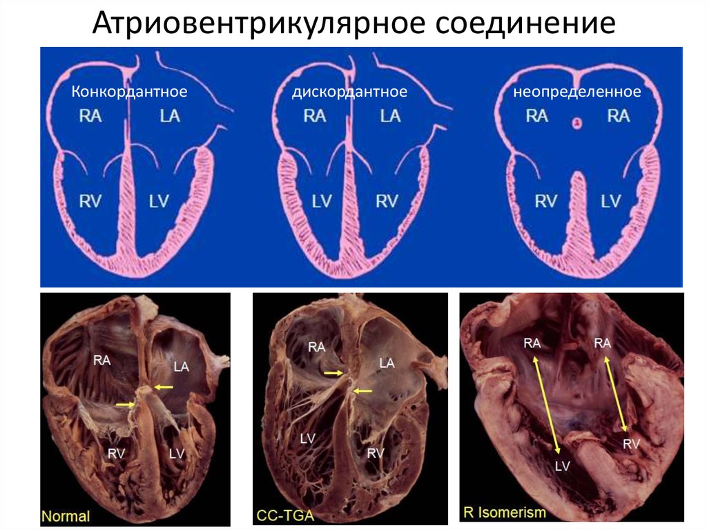 Открытый атриовентрикулярный канал презентация