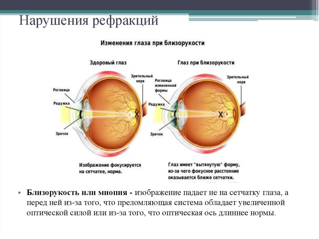 Анизометропия это в офтальмологии